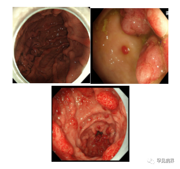 [中南大学湘雅医院]关注罕见病：拉肚子、指甲变皱、脱发、皮肤暗沉…有可能是这个病!w11.jpg