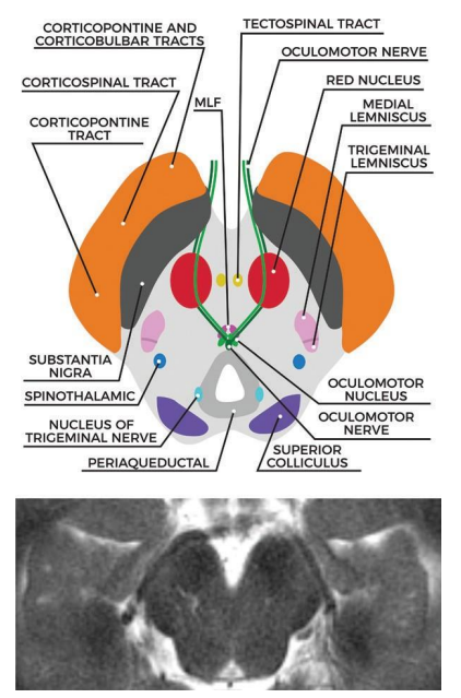图文并茂：一文掌握中脑解剖结构及常见综合征w3.jpg