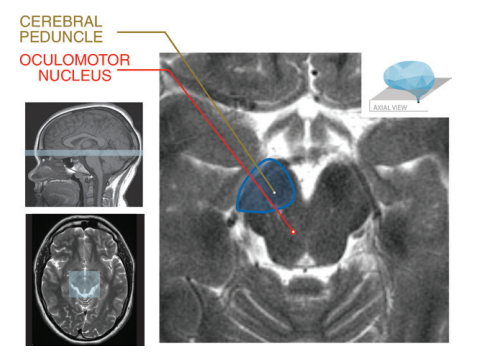 图文并茂：一文掌握中脑解剖结构及常见综合征w4.jpg
