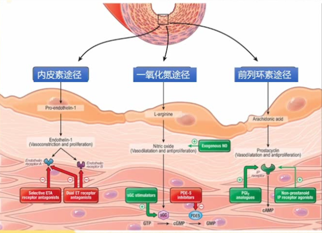 肺动脉高压，靶向药物三联治疗知多少?w2.jpg